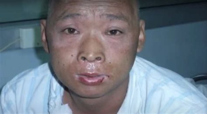Hisashi Ouchi: The Real Photos from the Hospital and His Incredible Story