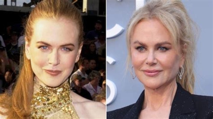 Nicole Kidman: The Evolution Through Plastic Surgery